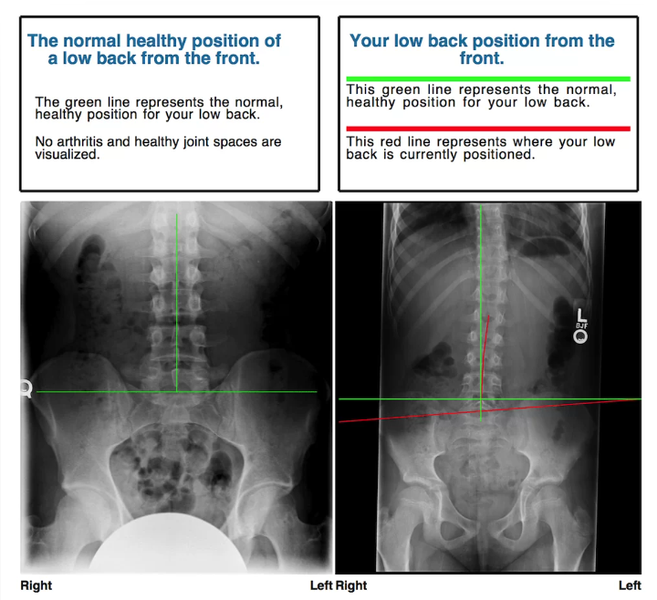 Chiropractor Oxenford New Patient Offer with X-rays