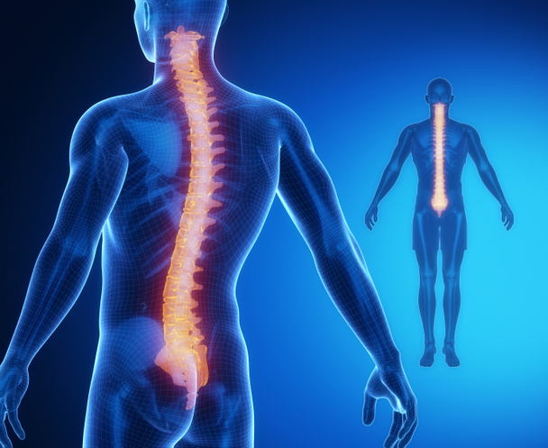 SCOLIOSIS